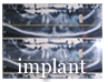 インプラント